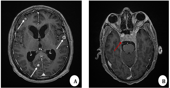  MRI brain T1W contrast-enhanced axial images