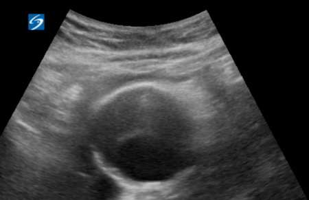 Point-of-care ultrasound demonstrating an infrarenal abdominal aortic aneurysm