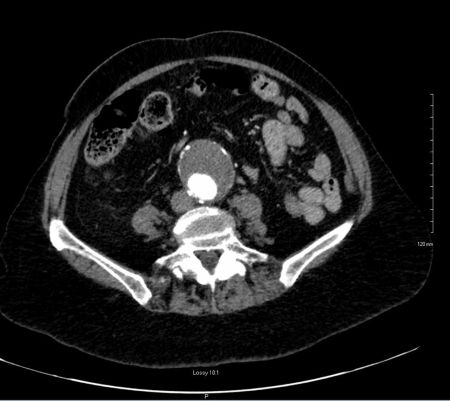 CTA image demonstrating extensive mural thrombus and a 5 cm infrarenal abdominal aortic aneurysm