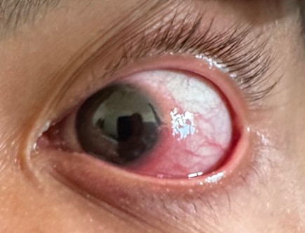 Diffuse anterior scleritis of the left eye at presentation, with localized redness and dilation of the episcleral vessels.