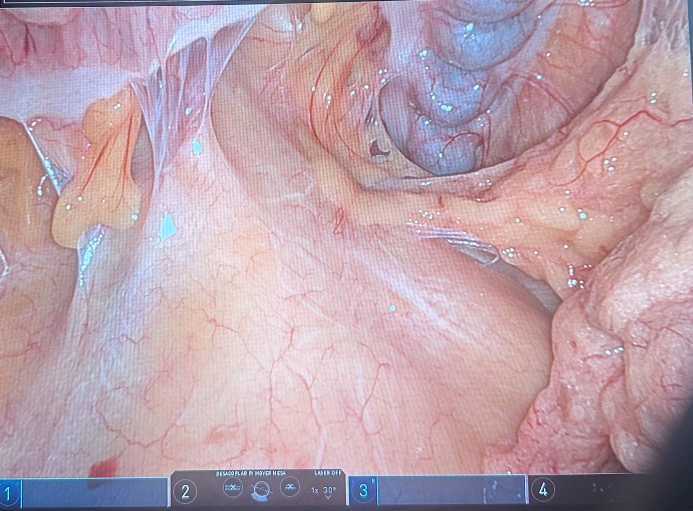 Extensive upper-abdominal adhesions involving the gastric 
remnant, jejunal limbs, transverse colon/mesocolon, and the previous 
operative field, requiring careful robotic adhesiolysis to expose the prior 
Billroth II gastrojejunostomy.
