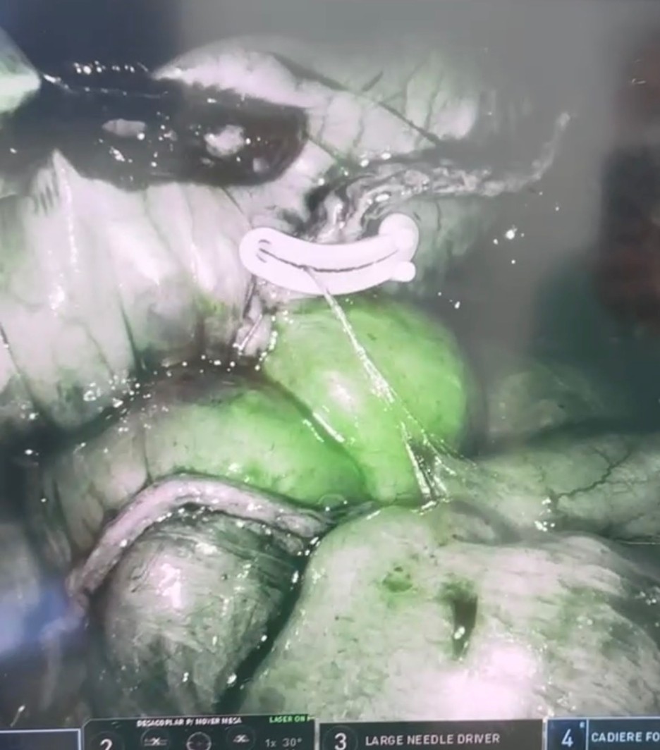 ICG fluorescence assessment of the newly constructed 
gastrojejunostomy, demonstrating prompt and homogeneous perfusion 
of the gastric and jejunal sides without a visible perfusion defect. The 
fluorescence findings did not prompt revision of the anastomosis.