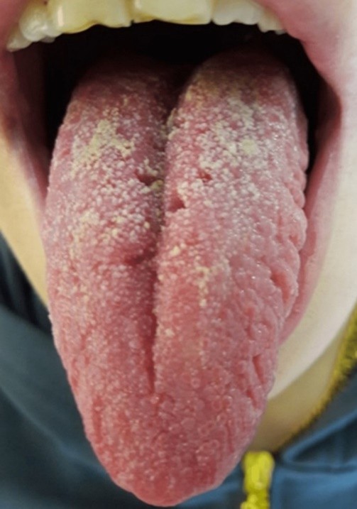 Photograph showing the fissured tongue.5.