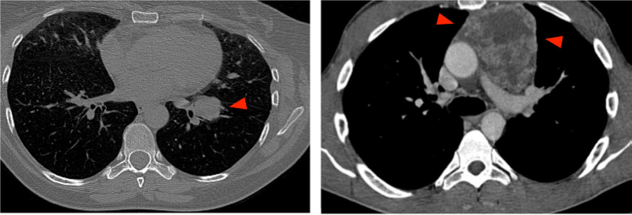 CT guided biopsy. Indications for FNAB (a) Mass lesion following
negative bronchoscopy (b) CNB of unknown mass in the anterior part of mediastinum.