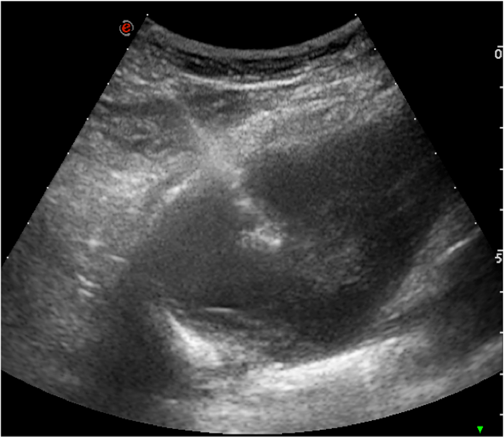 Ultrasound-guided FNB biopsy of a pulmonary nodule in the left
lower lobe. The needle was 20 G due to suspections of liquide nature of the lesion