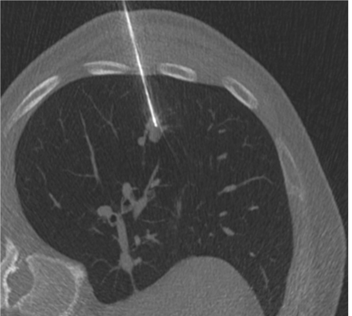 CT image presenting left pulmonary lobe . CT-guided Core chest
biopsy of a pulmonary nodule in the left lower lobe.
