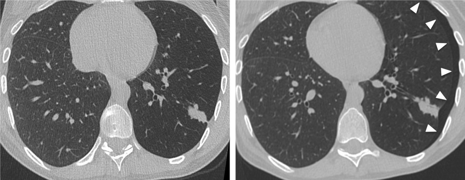 CT-guided chest biopsy (a) Axial CT image before the procedure
showing the left subpleural nodule; (b) Post-procedural axial CT image
showing small PNX (arrows) as a complication of transthoracic