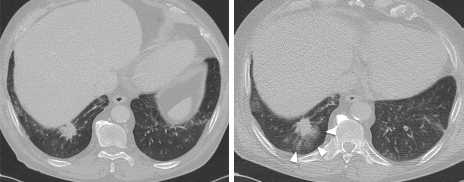 CT-guided chest biopsy of a pulmonary nodule (a) Axial CT image
showing a pulmonary nodule in the right lower lobe; (b) Postprocedural
CT image demonstrates perilesional haemorrhage as ground-glass opacity around the nodule (arrows).