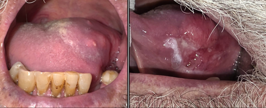 Figure 1. Proliferative mass featuring an exophytic white surface and 
ill-defined indurated margins, located in the left lateral border of the 
tongue, extending inferiorly to the floor of the mouth and the alveolar 
ridge of the mandible