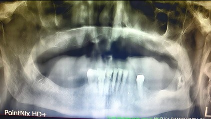 The mixed radiolucent/radiopaque image present in the left 
posterior mandibular region partially extending in the ramus.